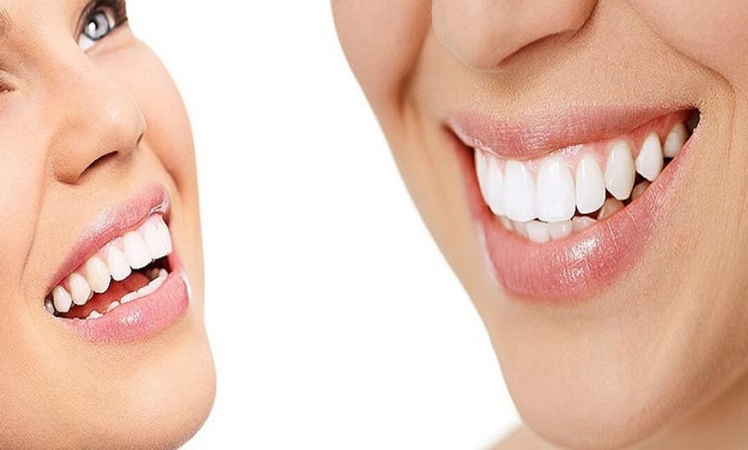 Femmes_et_santé_dentaire_:_l_éclaircissement_des_taches_blanches_sur_les_dents